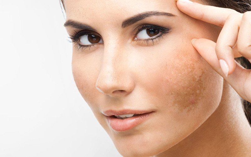 Tratamento do Melasma
